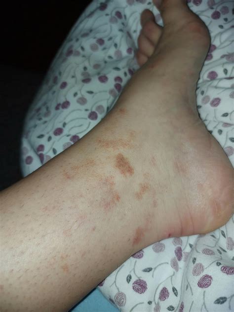 Allergy Of Cocoa at Doreen Woods blog