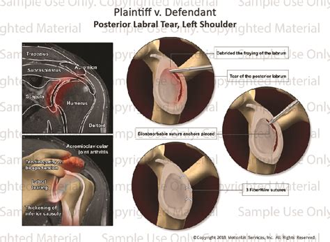 Posterior Labral Tear Injury Motionlit