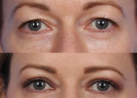 What Is Hooded Eye Surgery Your Definitive Guide To Blepharoplasty