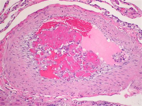 Pulmonary Thromboembolus Organizing Dr Yale Rosen Atlas Of Pulmonary Pathology Flickr