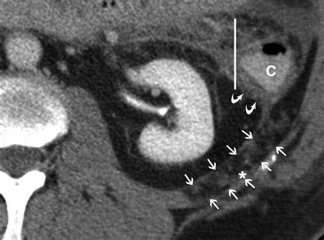 Acute Necrotizing Pancreatitis Laboratory Clinical And Imaging Findings As Predictors Of