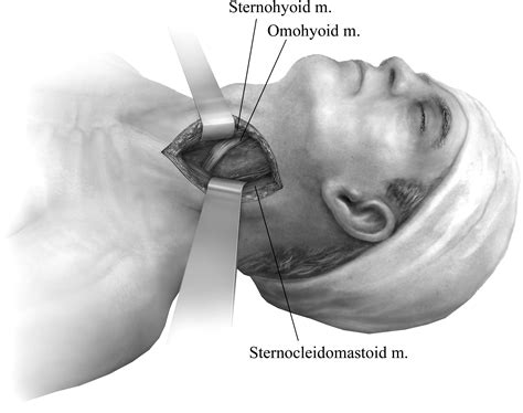 Primary Repair Of Esophageal Perforation Operative Techniques In