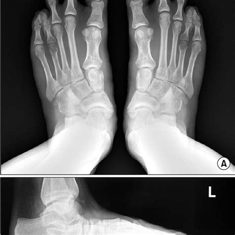 A Anteroposterior View Of Both Feet Shows Bilateral Multiple