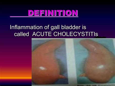 Acute Cholecystitis Ppt