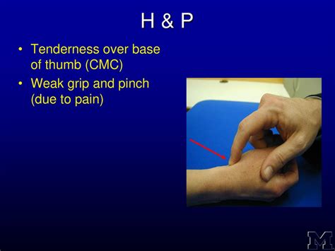 Surgical Management Of Arthritis Of The Base Of The Thumb Ppt Download