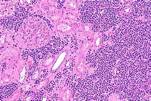 Marginal zone lymphoma - Libre Pathology