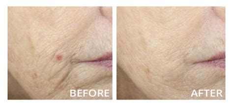 Vivace RF Microneedling Craig Singer MD Dermatology