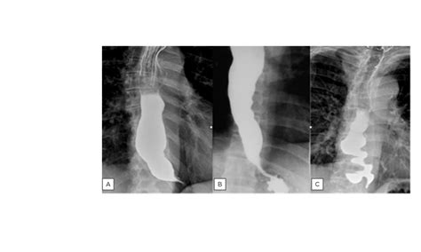 A Proposal For A New Prognostic Grading System In Achalasia Using