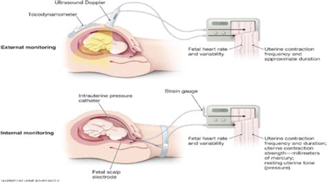 Abnormal Labor And Intrapartum Surveillance Flashcards Quizlet