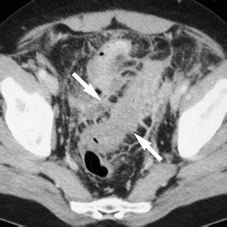 Diverticular abscess. CT scan obtained with oral and intravenous... | Download Scientific Diagram