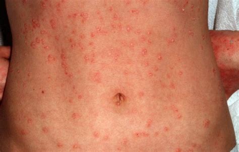 Guttate Psoriasis Pictures Symptoms Diet Treatment Home Remedies