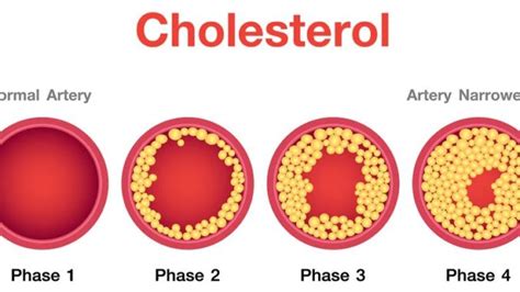 Cholesterol Types Importance Prevention And Treatment Public Health