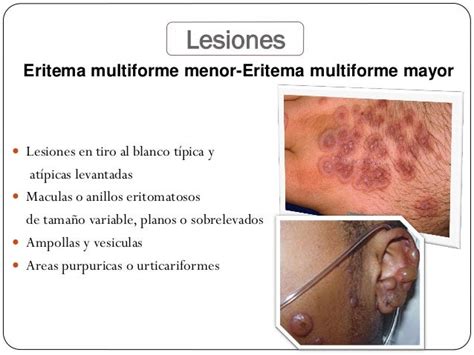 Eritema multiforme