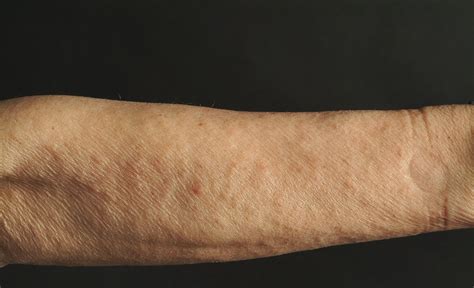 Reibeisenhaut Keratosis Pilaris G Nsehaut Als Dauerzustand