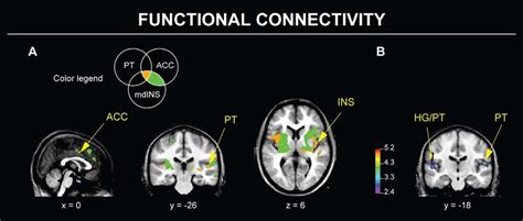 Functional Connectivity During Simple Singing Before And After