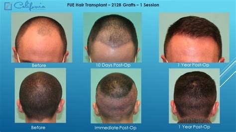 Follicular Unit Extraction Fue Hair Transplant In Walnut Creek San