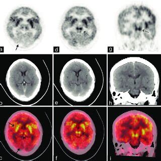 Axial F Fdg Pet Ct And Fused Pet Ct Brain Images A C Revealed