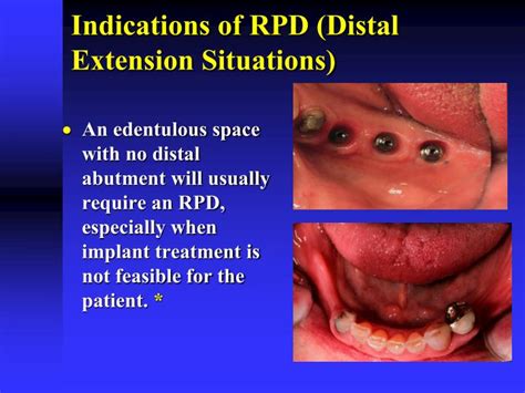 Ppt Introduction To Removable Partial Prosthodontics Powerpoint