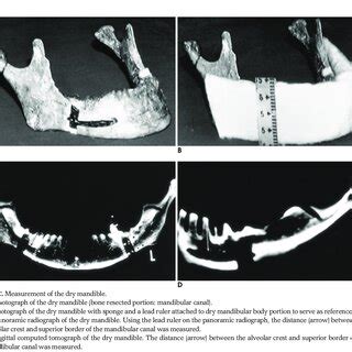 Mechanism Of The Inferior Alveolar Nerve Injury This Bony Specimen