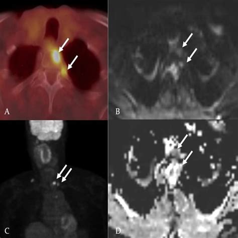 Diffusion Weighted Image A Apparent Coefficient Map B Axial