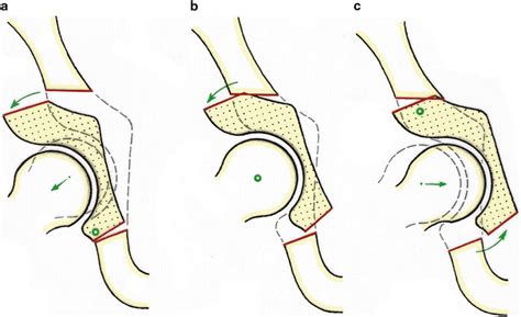 Surgical Technique: Periacetabular Osteotomy | Musculoskeletal Key