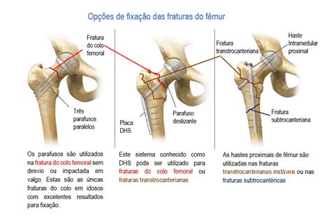 Fratura De F Mur Proximal Tratamento Dr M Rcio Silveira