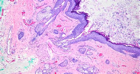 Dermoid Cyst Ovary Eye