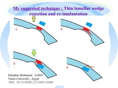 Keratotorus pellucid marginal degeneration | PPT