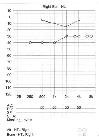 Conductive Hearing Loss Audiogram