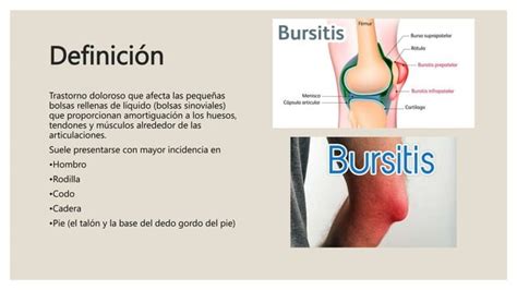 Definici N Causas S Ntomas Y Tratamiento De La Bursitis Pptx