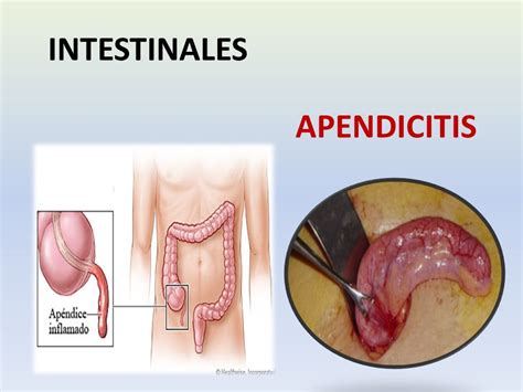 Cuidado Con El Apendicitis Dxn Salud Y Belleza ~ Dxn Salud Y Belleza