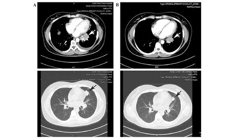 Advanced Squamous Lung Carcinoma In A Patient Experiencing Long Term