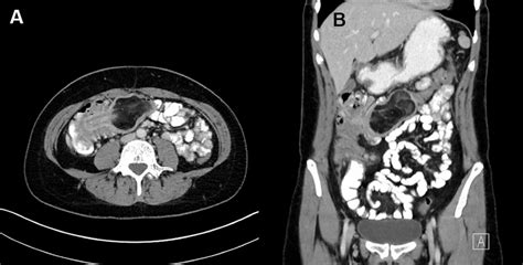 Rare Cause Of Colonic Intussusception In An Adult Bmj Case Reports