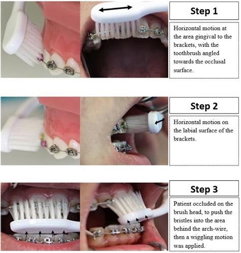 An Orthodontic Tooth Brushing Technique To Enhance Oral Hygiene In