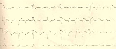 STEMI case examples - wikidoc