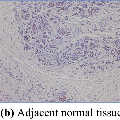 Immunohistochemical Analysis Of A Breast Cancer Tissue Array A Normal