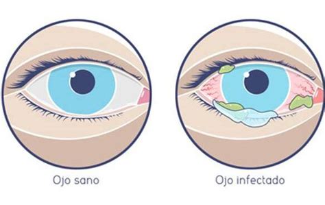 Duración De La Contagiosidad De La Conjuntivitis Lo Que Debes Saber