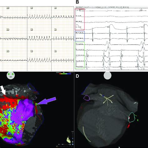 A Twelve Lead Electrocardiogram Ecg Recorded During Atrial