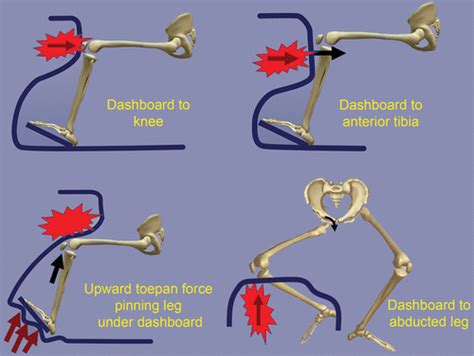 Pattern Recognition A Mechanism Based Approach To Injury Detection