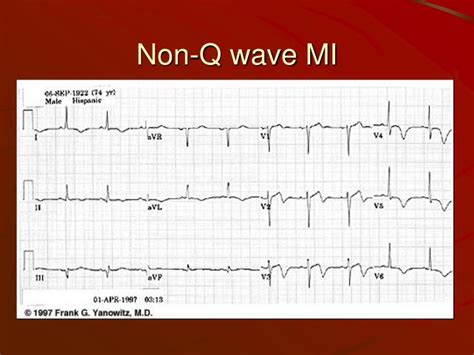 Ppt Ekg Myocardial Infarction And Other Ischemic States Powerpoint