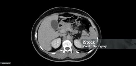 Ct Scan Thorax Dan Abdomen Foto Stok Unduh Gambar Sekarang Istock