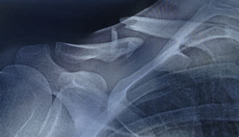 Les Fractures De La Clavicule