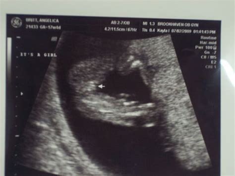 Let's post our Boy or Girl ultrasound Pictures! - BabyCenter