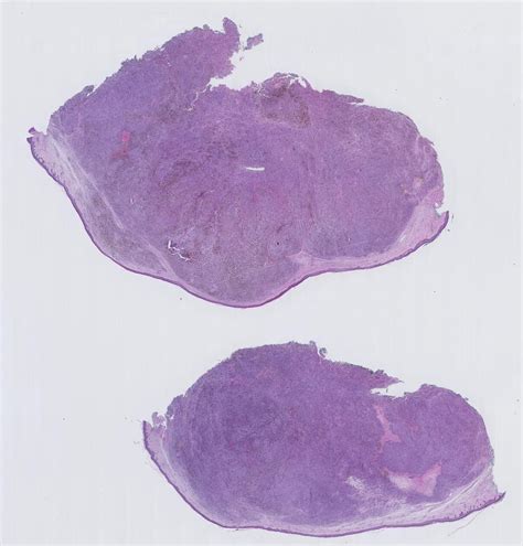 Metastatic Melanoma Kiko Xp