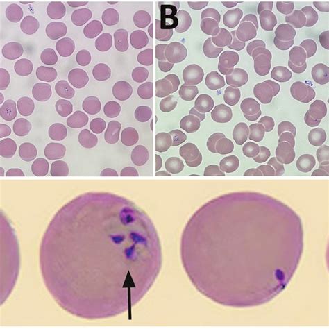 Figure Babesia Microti Detected On Wright Stained Peripheral Blood