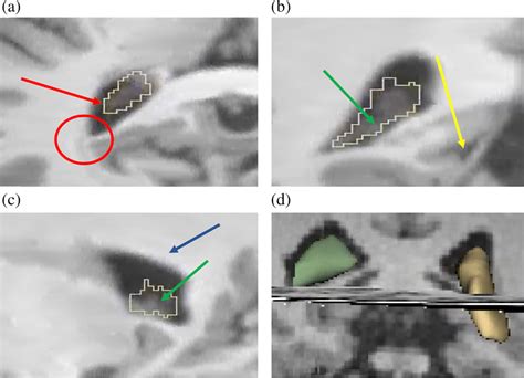 Manual Segmentation Of The Choroid Plexus Using Slicer A Axial View