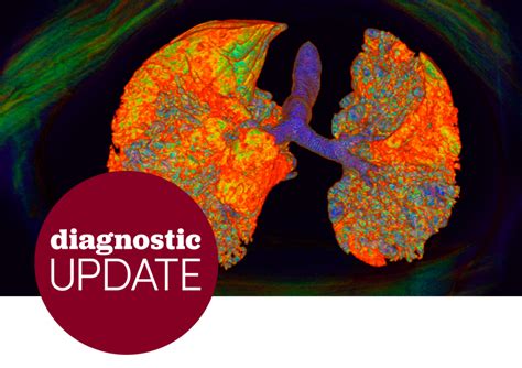 Improving the Diagnosis of Interstitial Lung Disease - Pulmonology Advisor