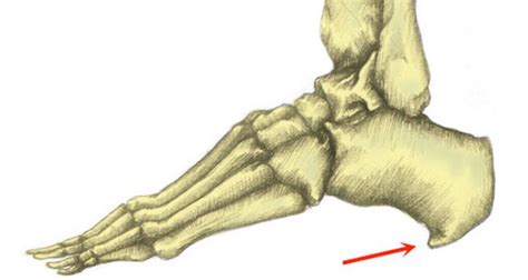 Bruised Heel - Symptoms, Causes, Treatment & Taping