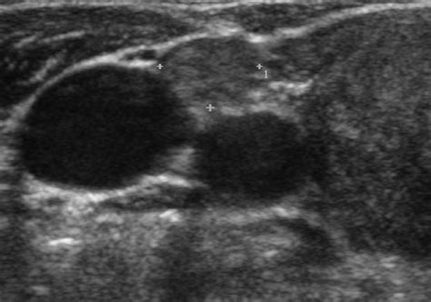 Us Image Of A 64 Year Old Female With Papillary Thyroid Carcinoma A