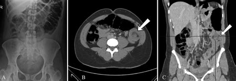 Radiological Findings Aaxr Gaseous Distention Of The Colon As Far